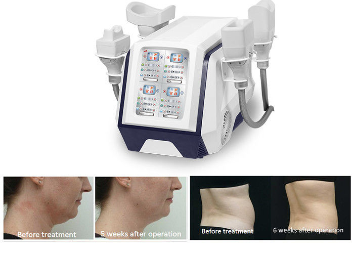 Portable 360 ​​Cryolipolysis Body Slimming Machine 1000W Untuk Menurunkan Berat Badan Pembakaran Lemak